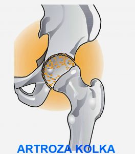 bolecine v krizu in kolku, artroza kolka