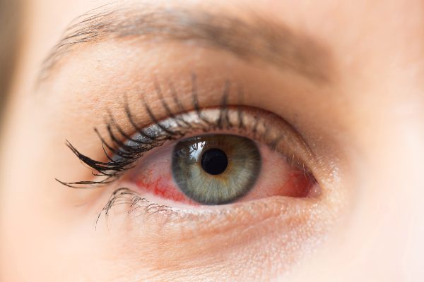 rdeče oči so značilne za suhe oči, zato negujmo veke